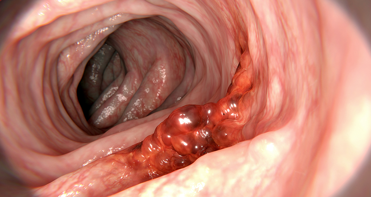 大腸カメラ検査の様子