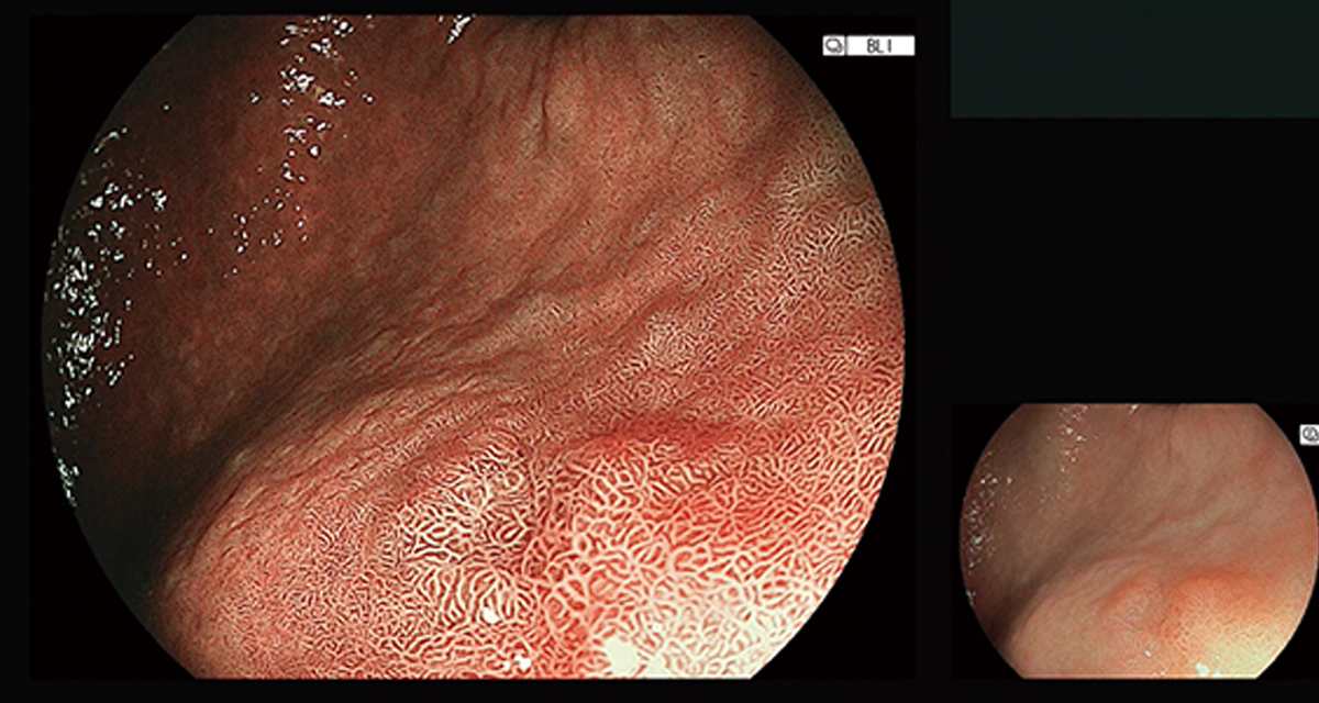 胃カメラ検査の様子